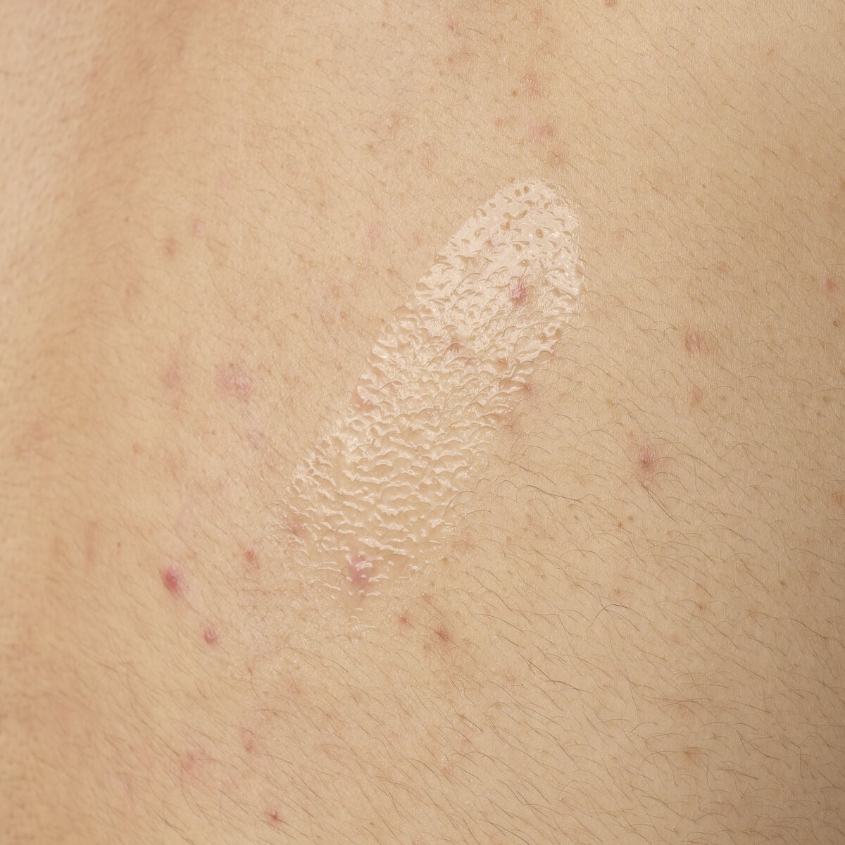 salicylic-acid-0-5-body-serum-x3 ORD-salicylic-acid-05-body-240ml-application.jpg