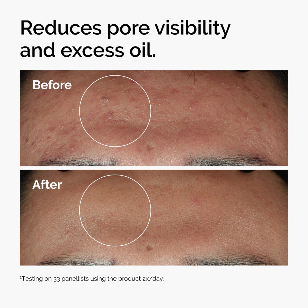niacinamide-10-zinc-1-k8 ord-niacinamide-zinc-blemish-serum-before-after-pores.jpg