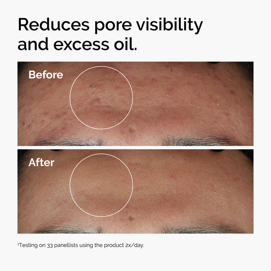 niacinamide-10-zinc-1-k8 ord-niacinamide-zinc-blemish-serum-before-after-pores.jpg