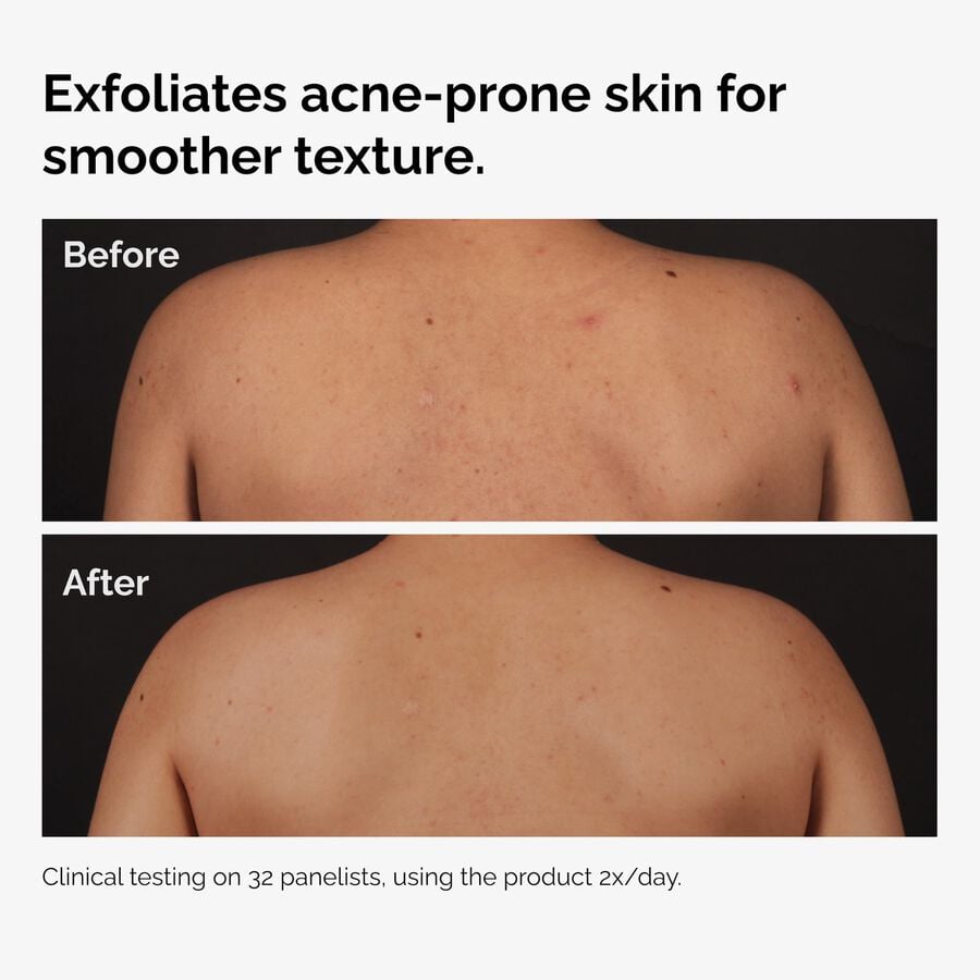 salicylic-acid-0-5-body-serum-x3 ord-salicylic-acid-body-serum-before-after-graphic-NA.jpg