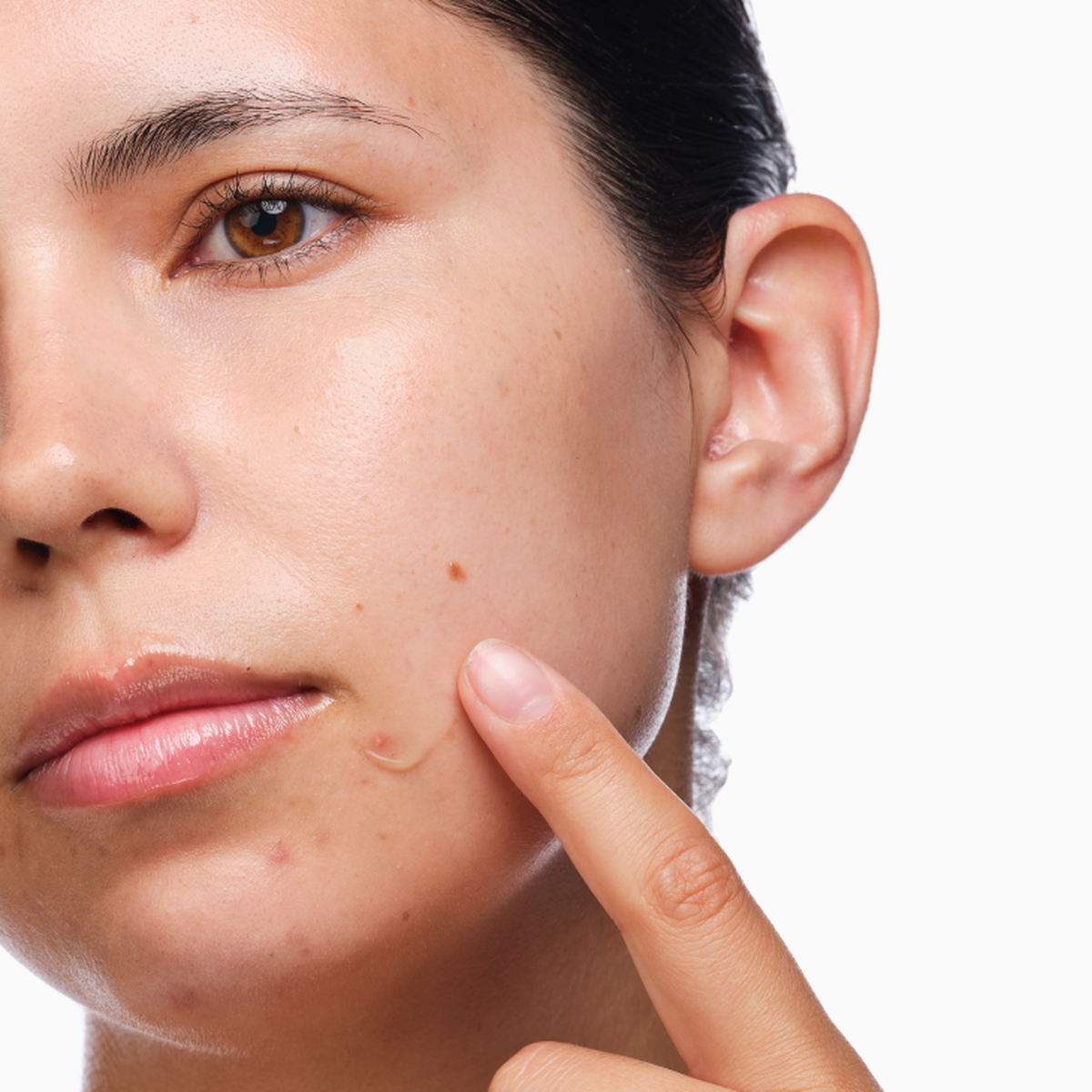 the-acne-set-x9 rdn-the-acne-set-application.png